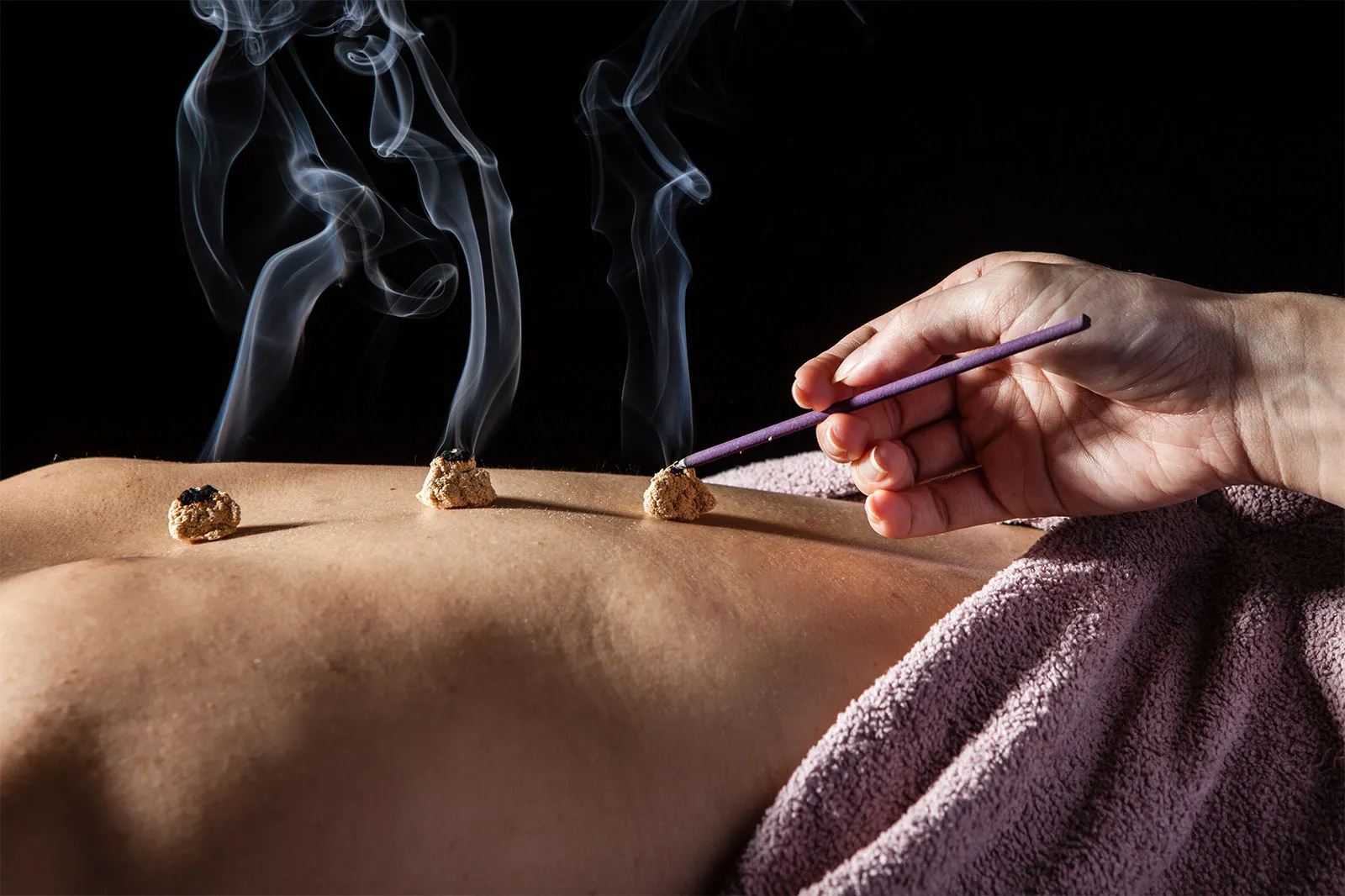 Moxibustion cones and moxa treatment points with acupuncture Treatement
