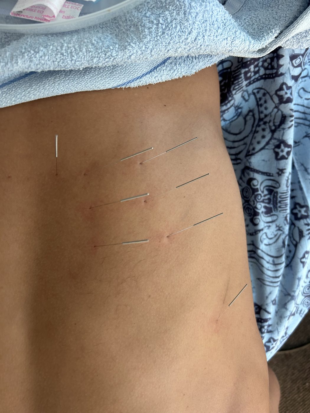 Acupuncture needles placed along the back during treatment