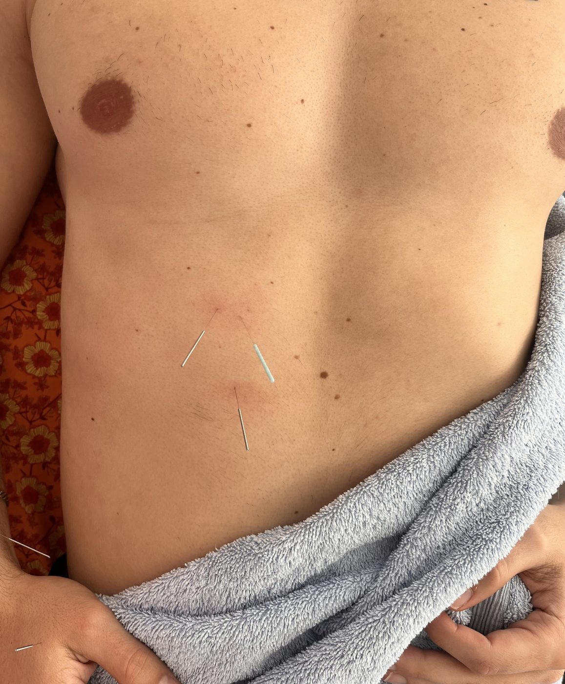 Cupping marks across the upper body after treatment