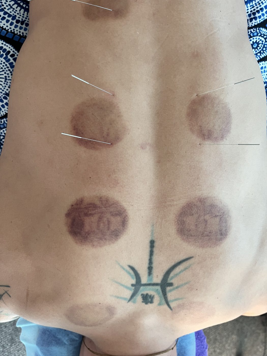 Cupping marks and acupuncture needles across the back
