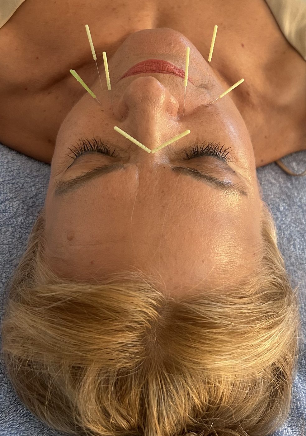 Constitutional facial acupuncture treatment at Vantage Point Acupuncture