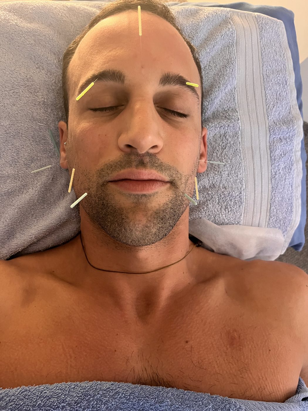 Constitutional facial acupuncture treatment at Vantage Point Acupuncture