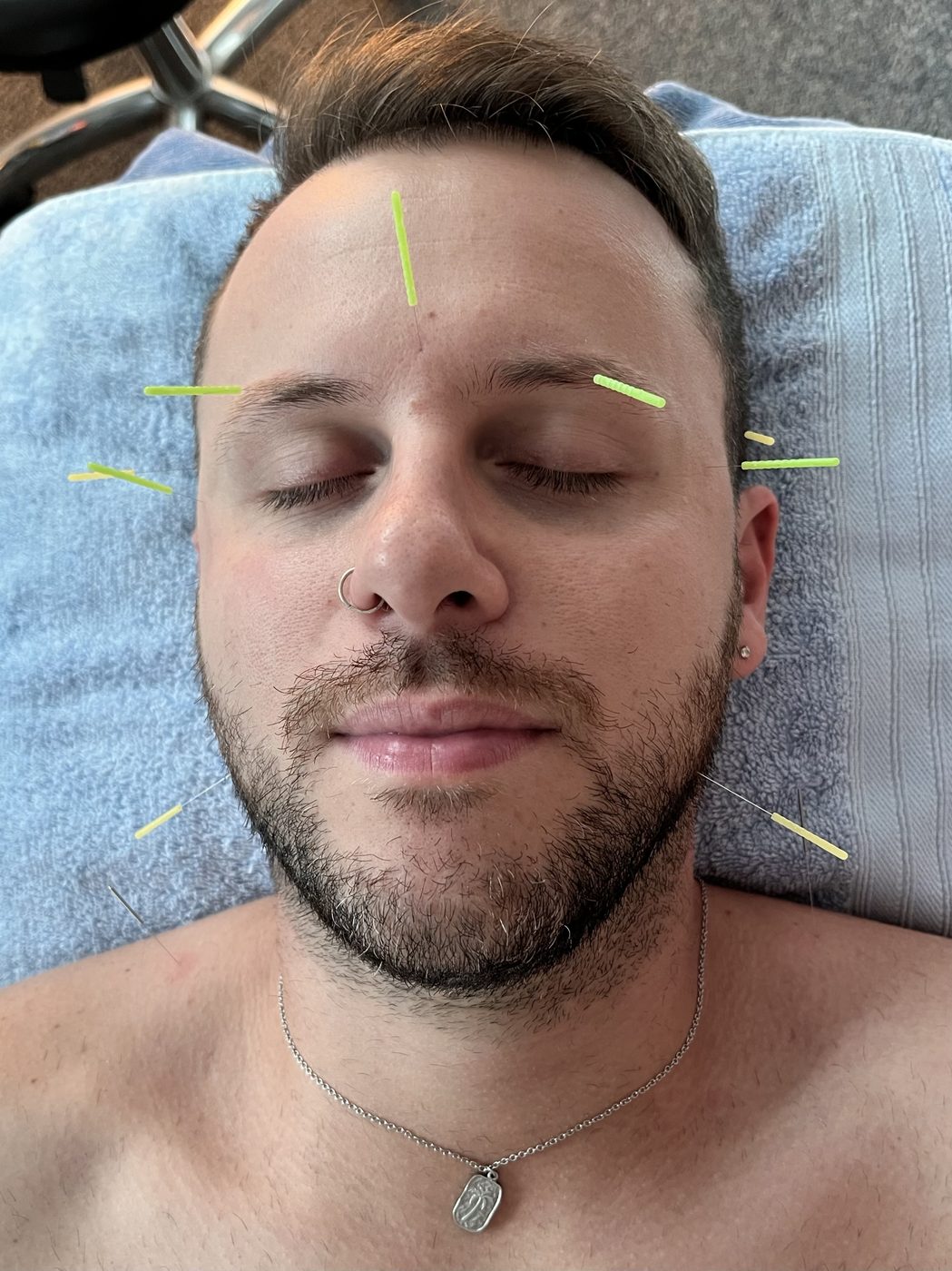 Constitutional facial acupuncture treatment at Vantage Point Acupuncture