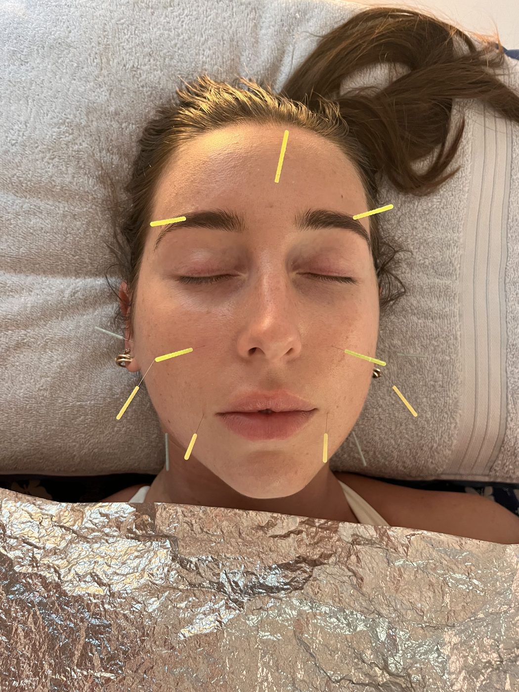 Constitutional facial acupuncture treatment at Vantage Point Acupuncture