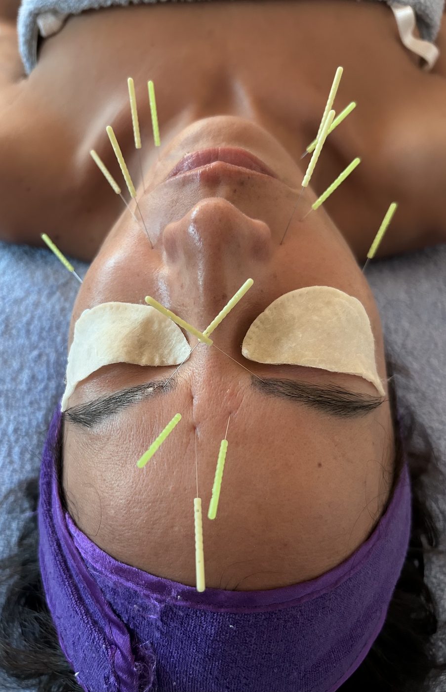 Facial acupuncture treatment with eye pads