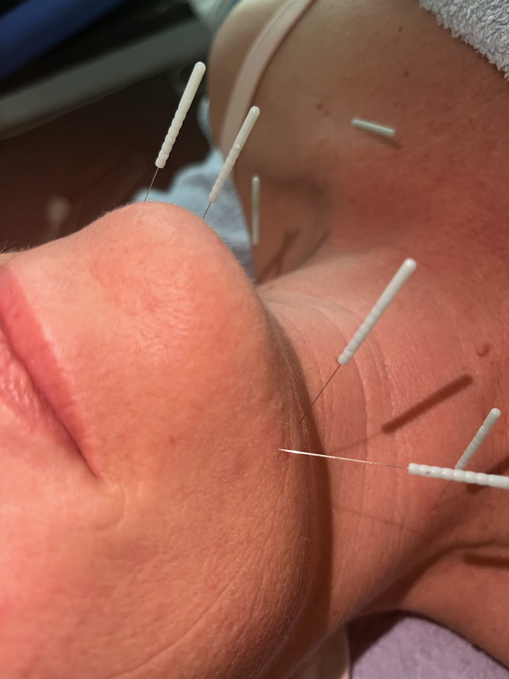 Close view of facial acupuncture needling