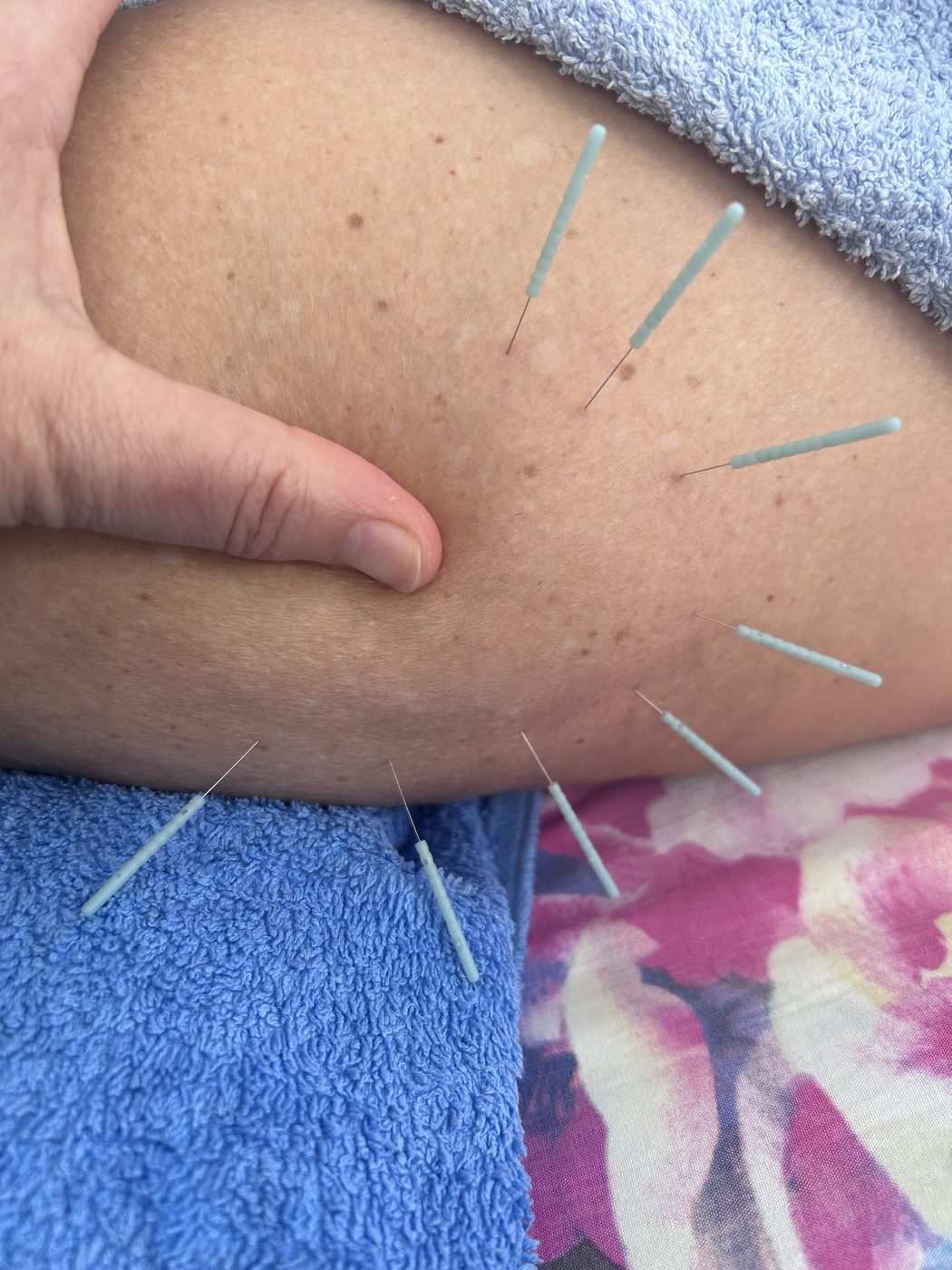 Acupuncture needling around the hip