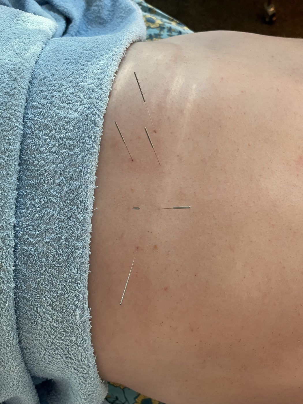 Acupuncture needles placed across the lower back