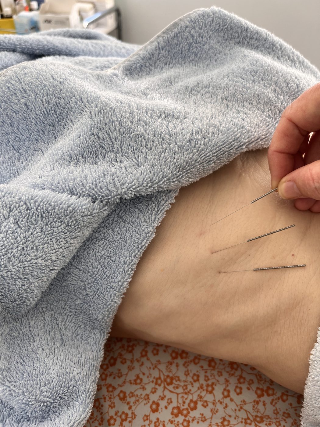 Acupuncture needles placed along the ribs and side